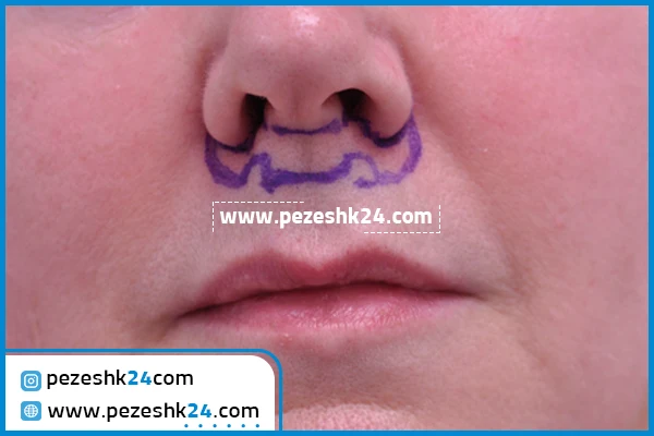 فوق تخصص سانترال لب در شیراز