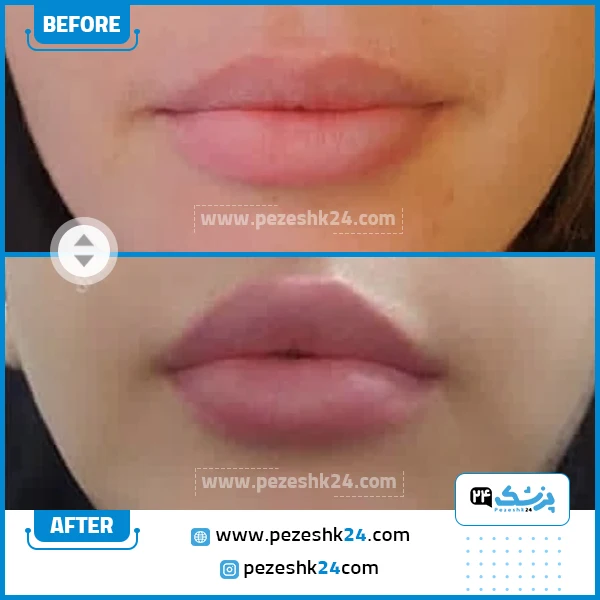 نمونه جراحی لیفت لب دکتر موسوی 1