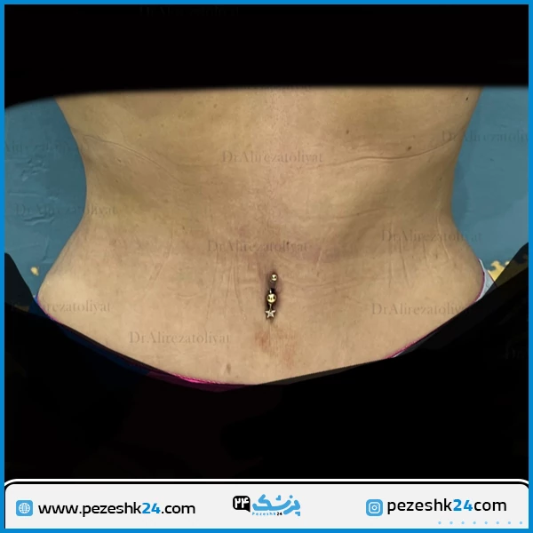 نمونه جراحی ابدومینوپلاستی دکتر تولیت