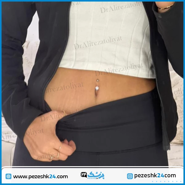 نمونه جراحی ابدومینوپلاستی دکتر تولیت در تهران
