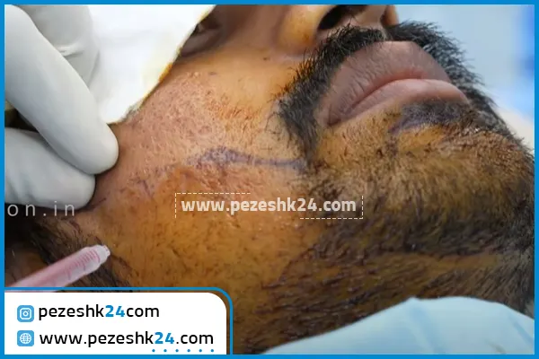 نمونه کاشت ریش در مشهد