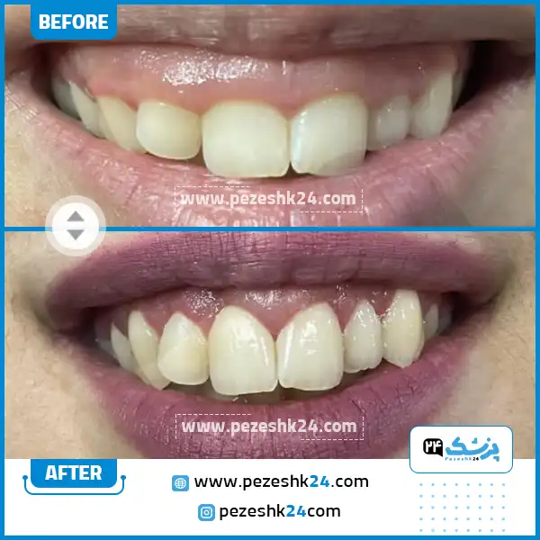 قبل و بعد کامپوزیت دندان دکتر هاشمی تهران