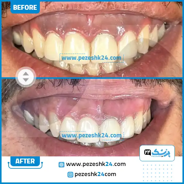 نمونه کامپوزیت دندان دکتر هاشمی تهران