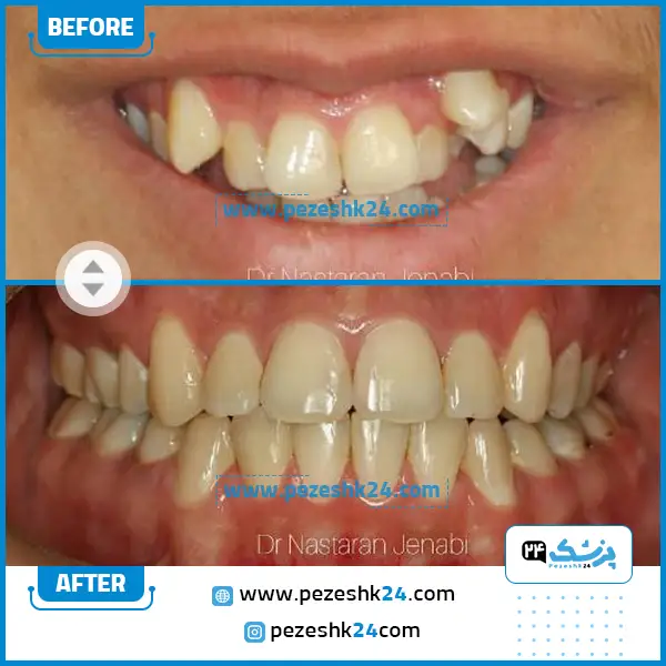قبل و بعد ارتودنسی دکتر جنابی اصفهان