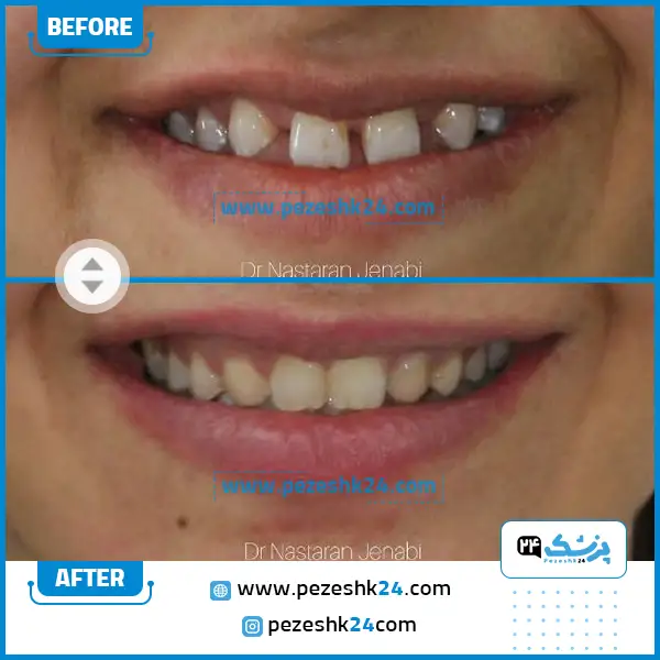قبل و بعد ارتودنسی دکتر جنابی اصفهان