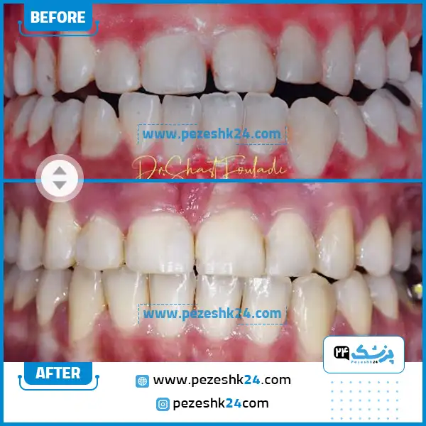 قبل و بعد ارتودنسی دندان دکتر شصت فولادی