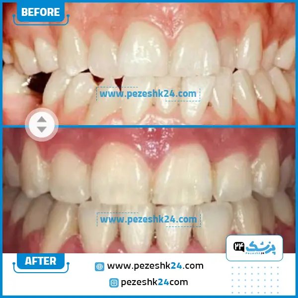 قبل و بعد ارتودنسی دکتر شیربان