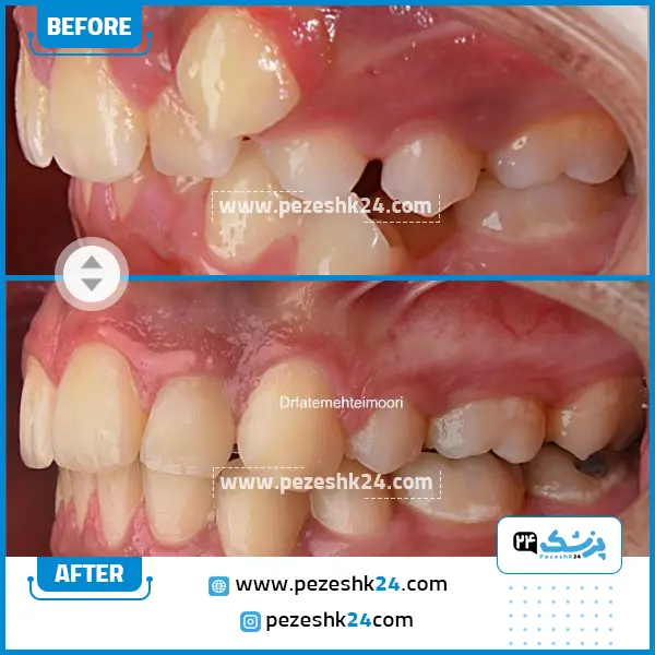 قبل و بعد ارتودنسی دندان دکتر تیموری