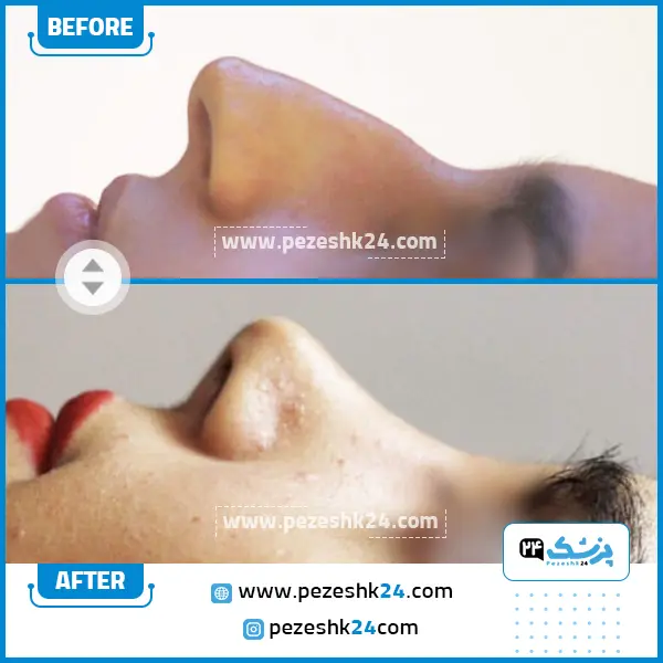 قبل و بعد رینوپلاستی دکتر حسین زاده ساری
