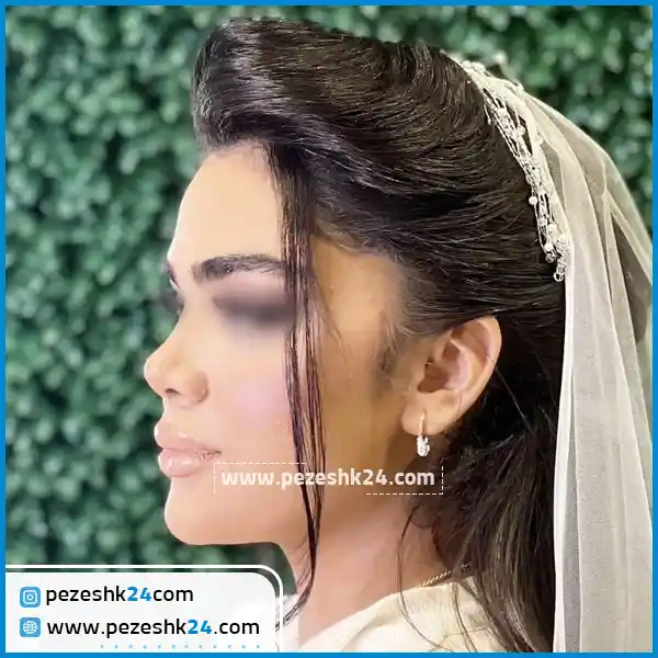 نمونه عمل بینی دکتر حسین زاده ساری