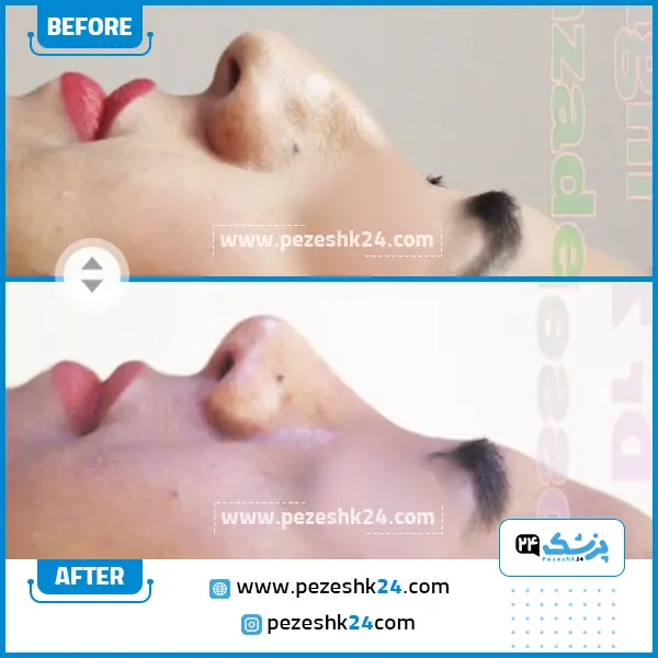 قبل و بعد جراحی بینی دکتر حسین زاده ساری