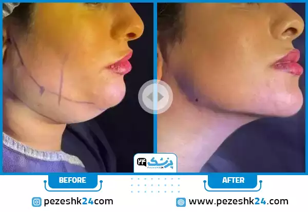 قبل و بعد جراحی زیبایی غبغب در رشت توسط دکتر علی خاکزاد
