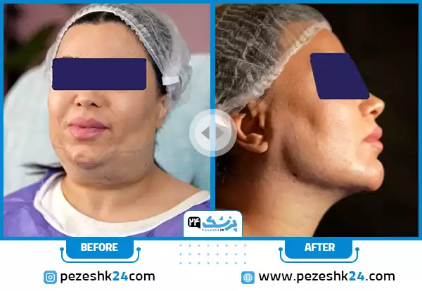 عکس قبل و بعد برداشتن غبغب در رشت توسط دکتر علی خاکزاد