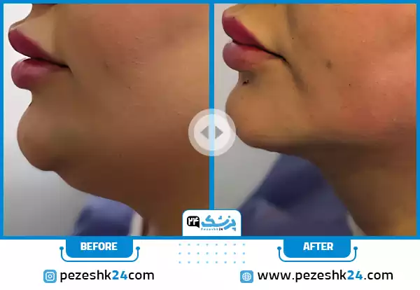 نمونه کار قبل و بعد عمل رفع غبغب در رشت توسط دکتر علی خاکزاد