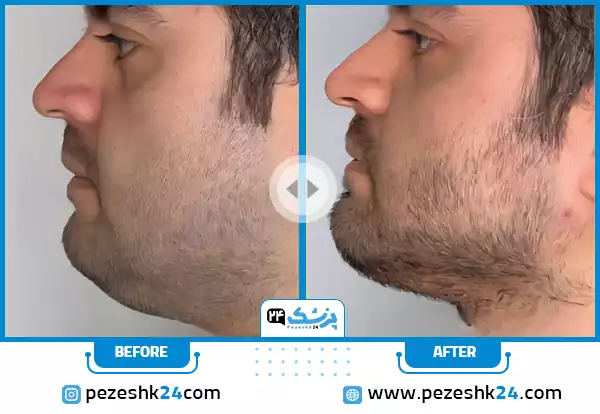نمونه کار قبل و بعد رفع غبغب در رشت توسط دکتر علی خاکزاد