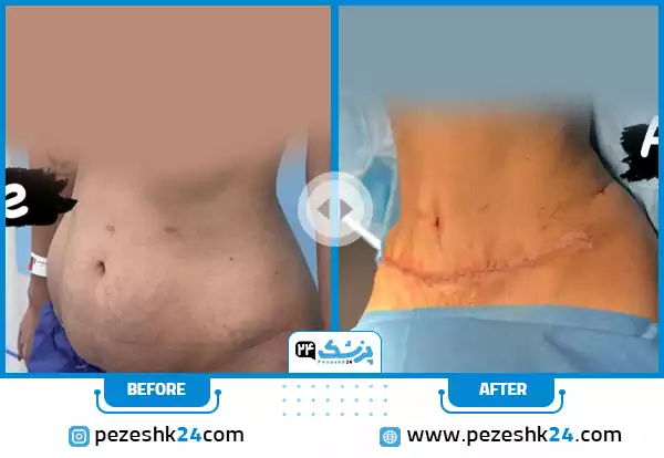 نمونه کار پیکر تراشی شکم و پهلو در اتاق عمل توسط دکتر منصور یحیاوی در مشهد
