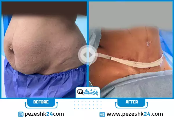 نمونه کار پیکر تراشی در اتاق عمل توسط دکتر منصور یحیاوی در مشهد