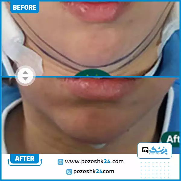 نمونه کار جراحی غبغب از روبرو توسط دکتر شهروز امانی در رشت
