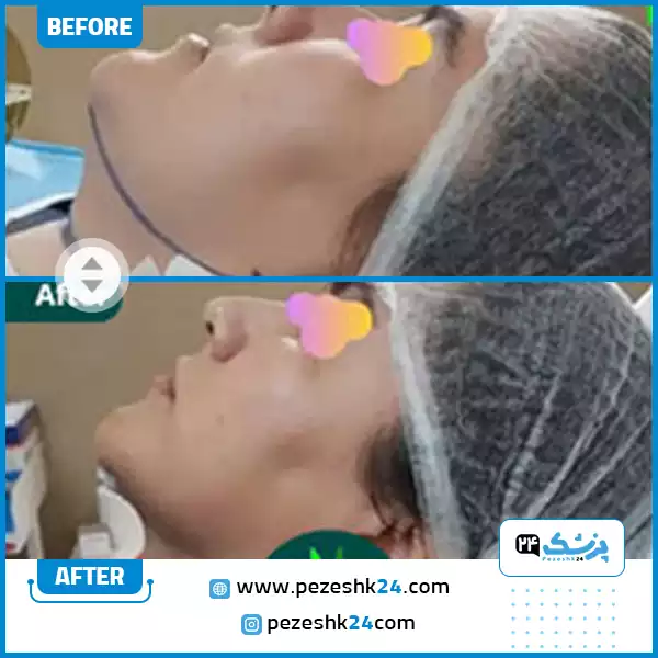 نمونه کار قبل و بعد جراحی غبغب توسط دکتر شهروز امانی در رشت