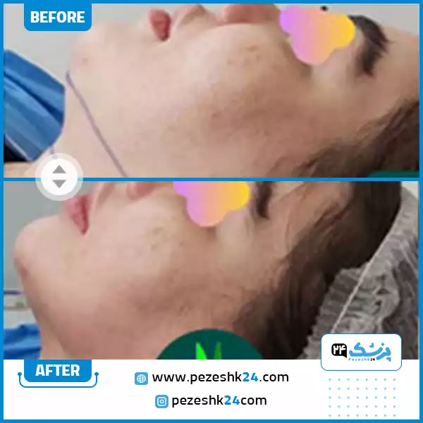 نمونه کار قبل و بعد جراحی غبغب با زاویه سازی فک توسط دکتر شهروز امانی در رشت