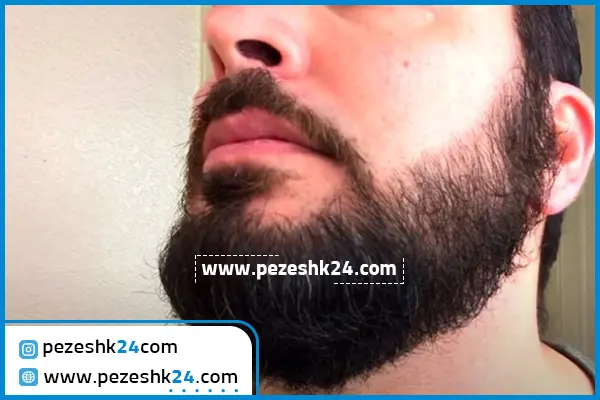 کاشت ریش و سبیل مشهد