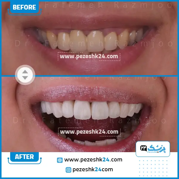 نمونه کار لمینت دندان دکتر رزمجو 1
