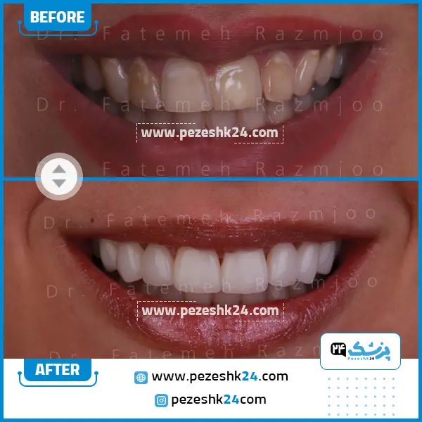 نمونه کار لمینت دندان دکتر رزمجو 2