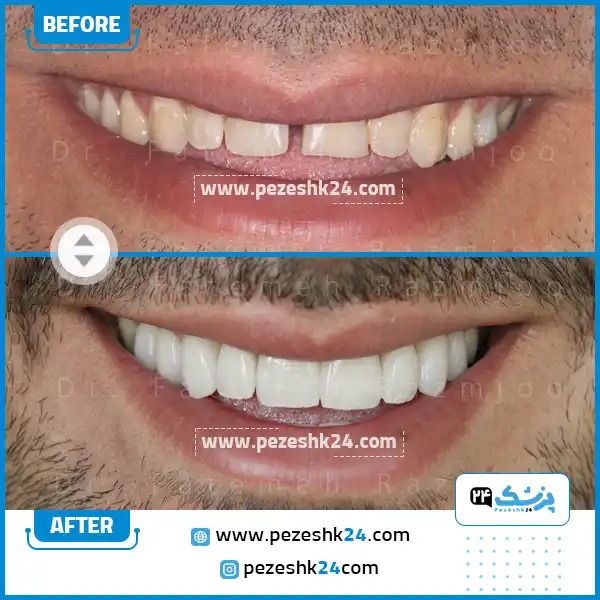 نمونه کار لمینت دندان دکتر رزمجو 3