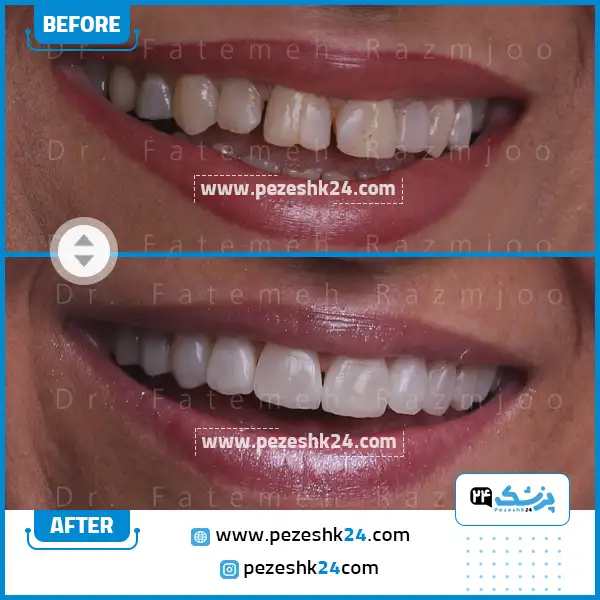 نمونه کار لمینت دندان دکتر رزمجو 4