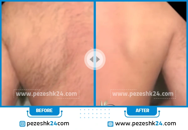 قبل و بعد لیزر در کلینیک نوران تهران