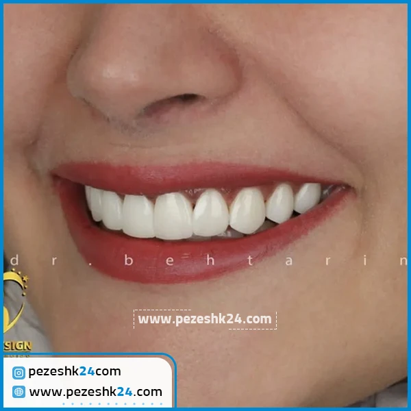 نمونه کامپوزیت دندان دکتر بهتری نژاد