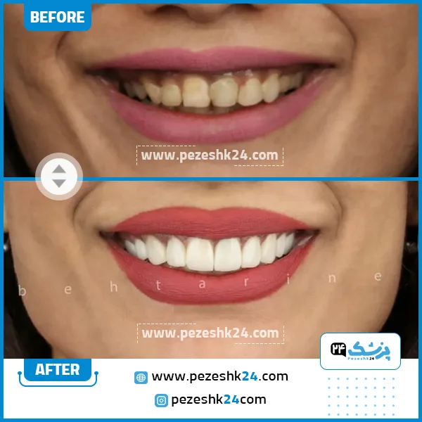 قبل و بعد کامپوزیت دکتر بهتری نژاد