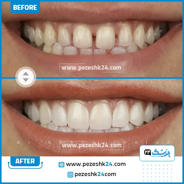 قبل و بعد کامپوزیت دکتر بهتری نژاد شیراز