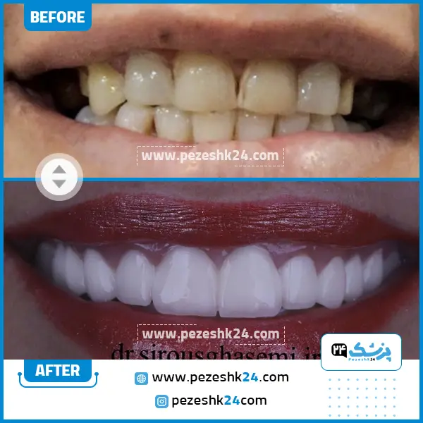 قبل و بعد کامپوزیت دندان دکتر سیروس قاسمی
