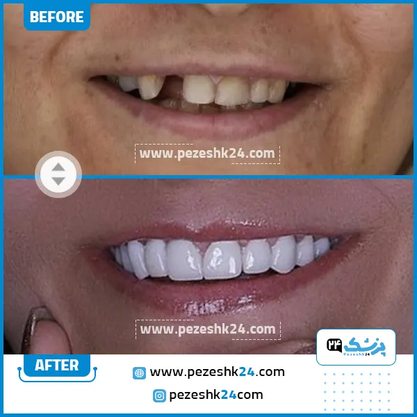 قبل و بعد کامپوزیت دکتر سیروس قاسمی