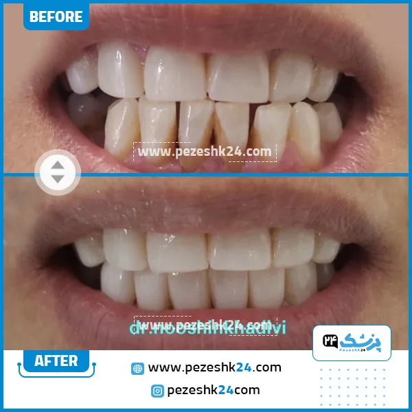 قبل و بعد کامپوزیت دندان دکتر نوشین خدیوی