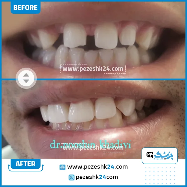 قبل و بعد کامپوزیت دندان دکتر خدیوی شیراز