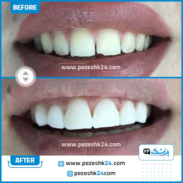 قبل و بعد کامپوزیت دندان دکتر سعادت روایی