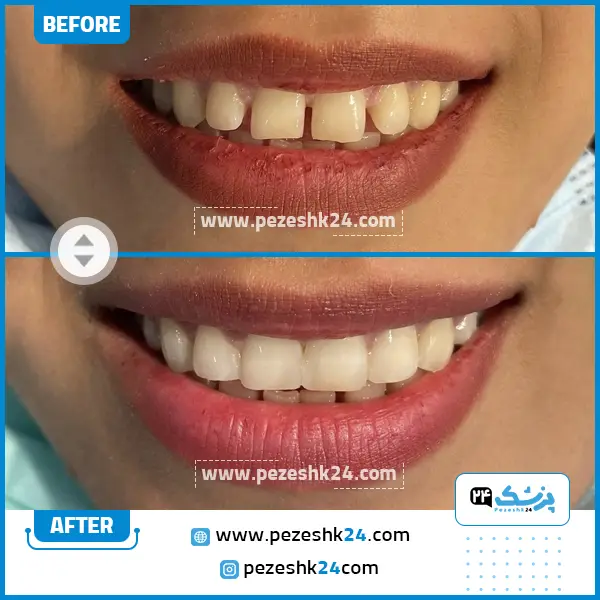 قبل و بعد کامپوزیت دندان دکتر روایی
