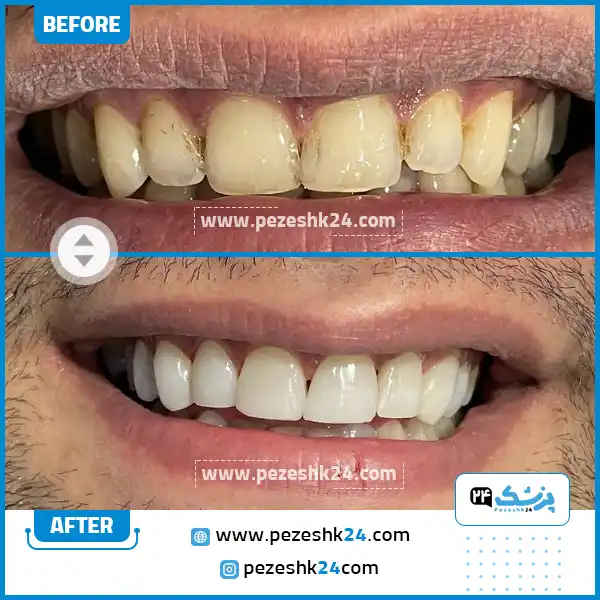 قبل و بعد کامپوزیت دکتر روایی