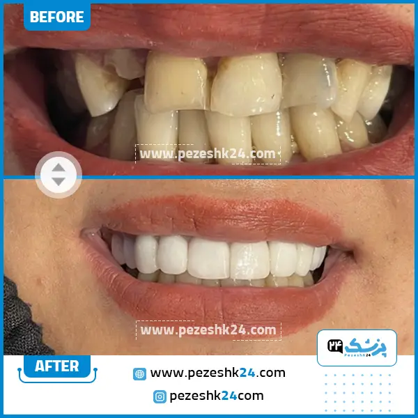 قبل و بعد کامپوزیت دکتر سعادت روایی شیراز