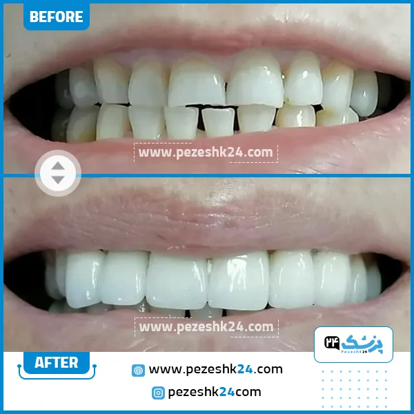 قبل و بعد کامپوزیت دندان دکتر علیرضا اقبال شیراز