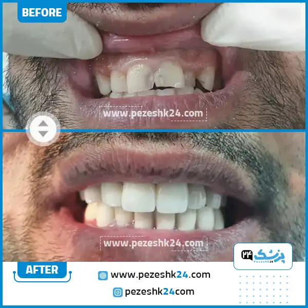 قبل و بعد کامپوزیت دندان دکتر علیرضا اقبال