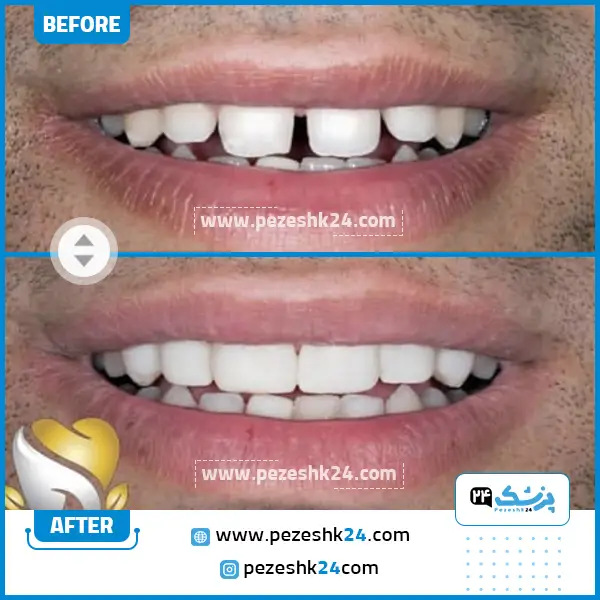 قبل و بعد کامپوزیت دندان دکتر اقبال شیراز