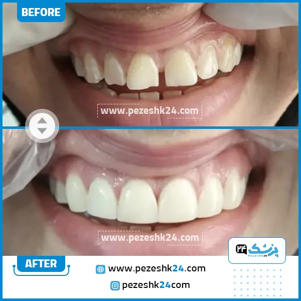 قبل و بعد ونیر کامپوزیت دکتر لیلا کریمی دندانپزشک شیراز