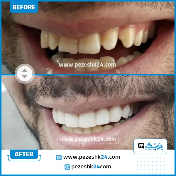 قبل و بعد کامپوزیت دندان دکتر لیلا کریمی دندانپزشک