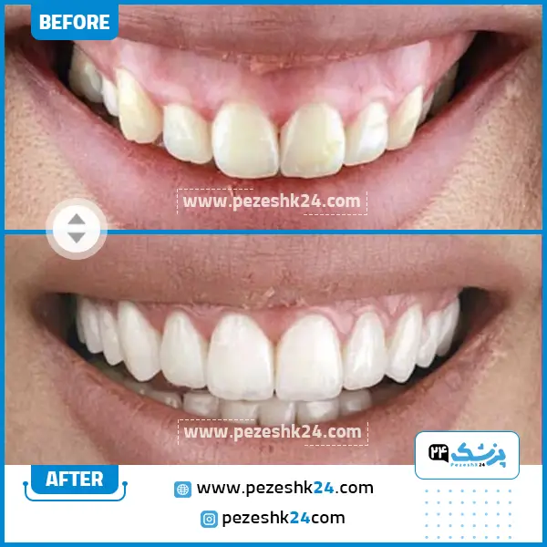 قبل و بعد کامپوزیت ونیر دکتر کریمی