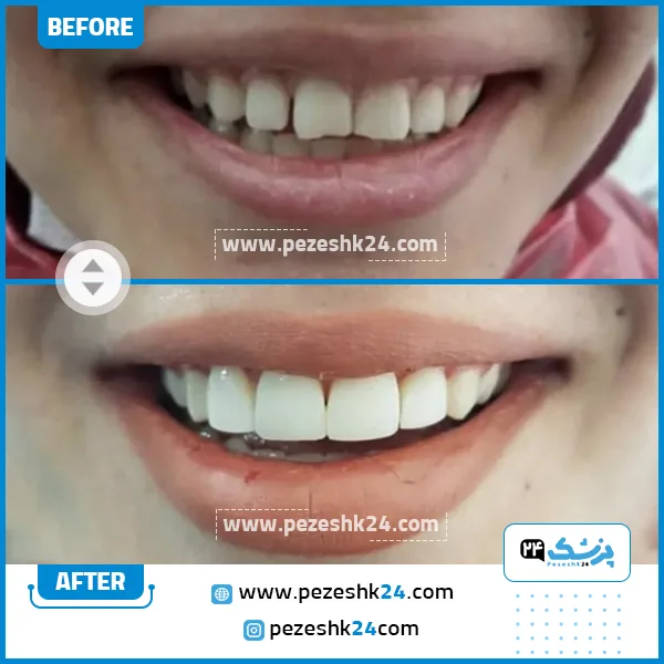قبل و بعد کامپوزیت دکتر لیلا کریمی دندانپزشک شیراز