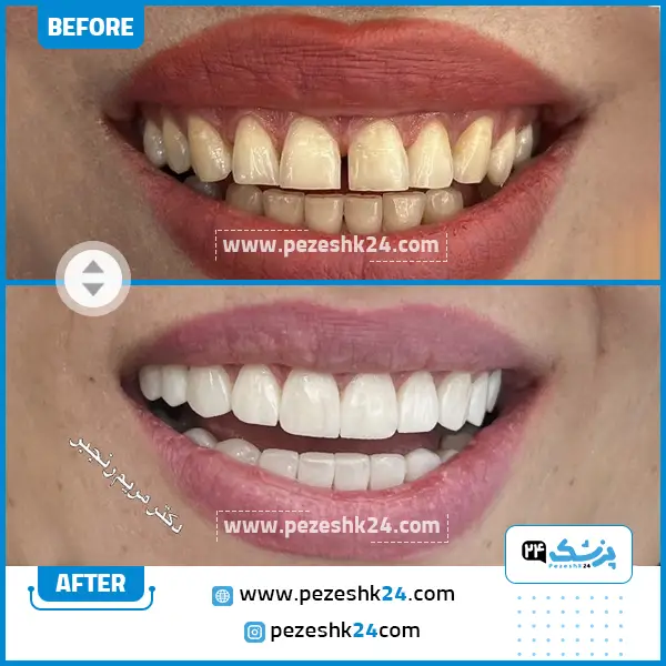 قبل و بعد کامپوزیت دندان دکتر رنجبر