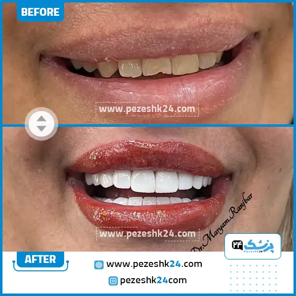 قبل و بعد کامپوزیت دکتر رنجبر شیراز
